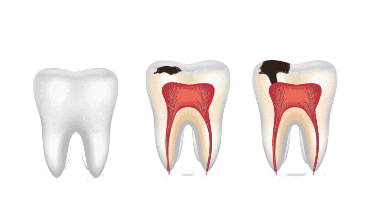 Esztétikus fogtömés
