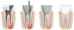 root_canal